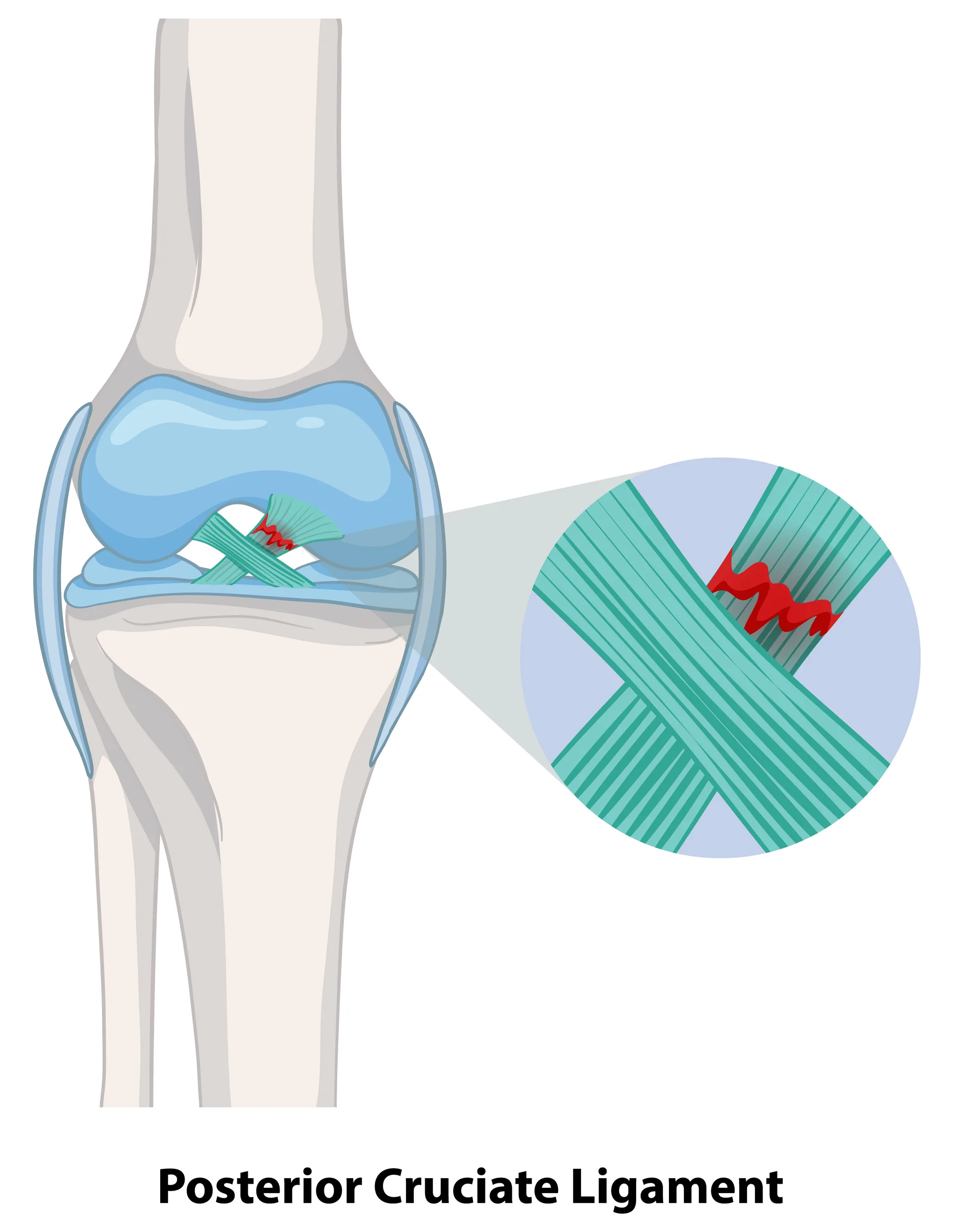 Partial Knee Replacement anatomy illustration