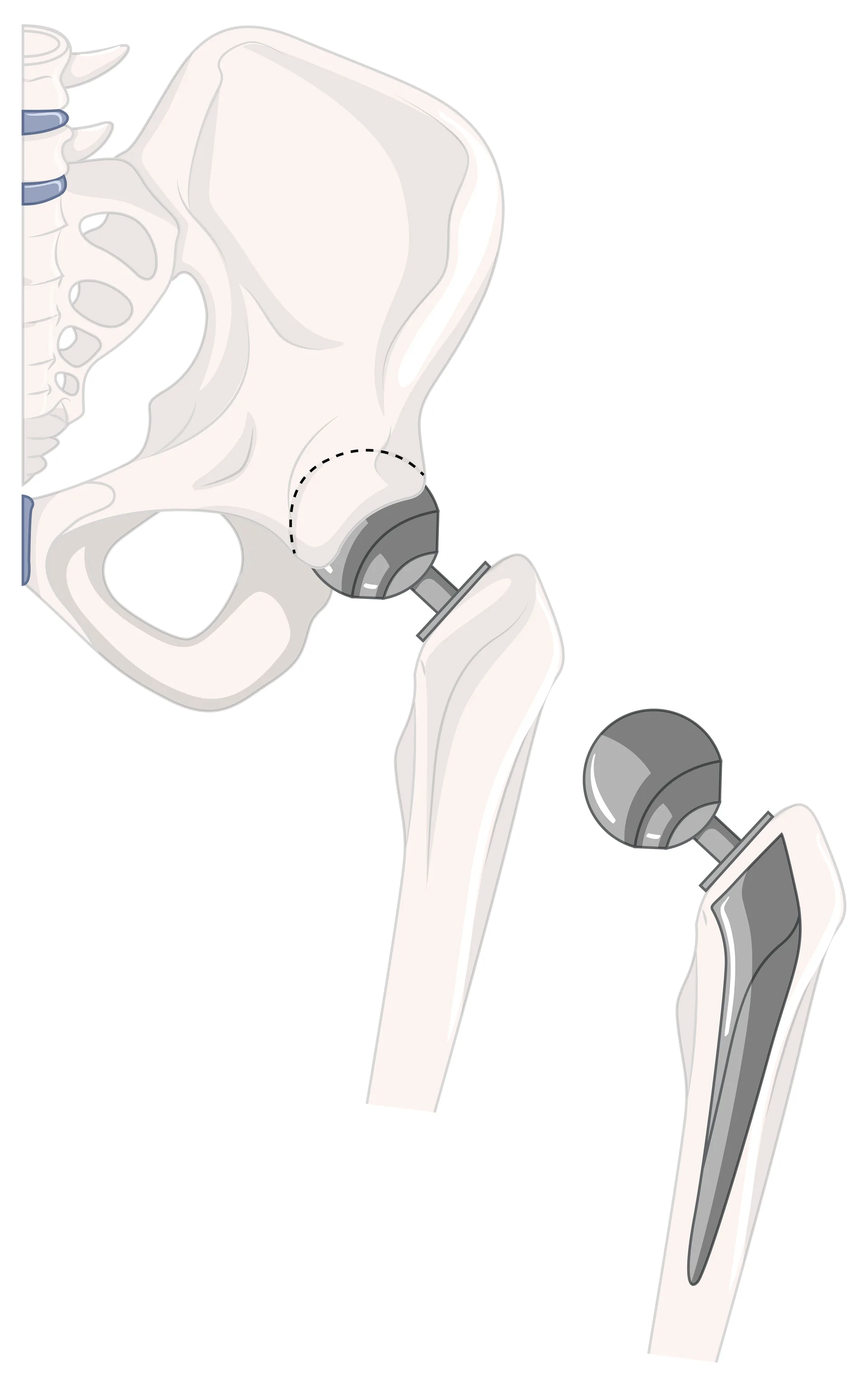 Revision Hip Replacement anatomy illustration